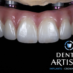 Dental Artistry Implants - Crowns - Veneers ( Westside ) Cosmetic Dentist in Bend