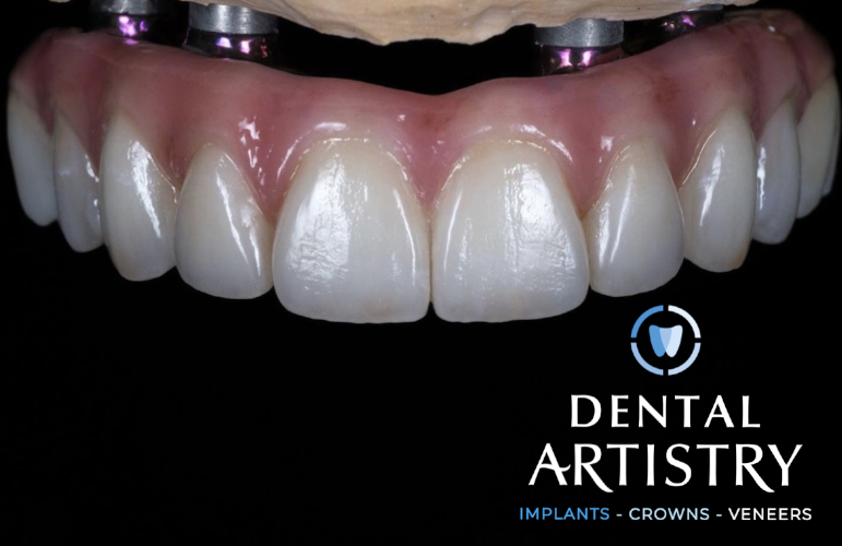 Negocio Dental Artistry Implants - Crowns - Veneers ( Westside )