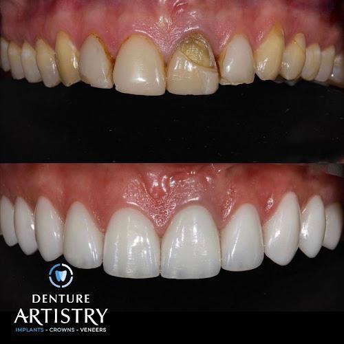 Negocio Dental Artistry Implants - Crowns - Veneers