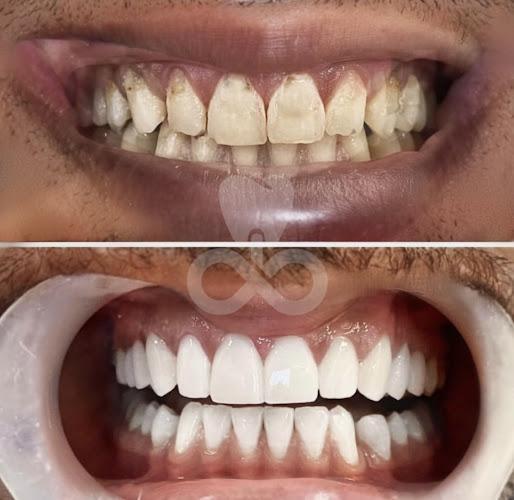 Negocio Forever Veneers