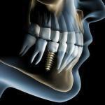 Metro West Dental & Implant Institute Cosmetic Dentist in Creve Coeur