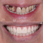 North Texas Dental Surgery Wisdom Teeth And Denture Implant Center Cosmetic Dentist in Plano