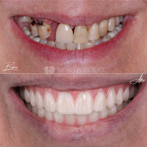 Negocio North Texas Dental Surgery Wisdom Teeth And Denture Implant Center