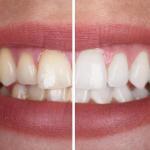 Oral Health Center-Cosmetic, Implant & Invisalign Dentist Westerville Cosmetic Dentist in Westerville