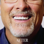 Shiny Smile Veneers Cosmetic Dentist in Houston