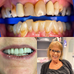 Smile Makeover Cosmetic Dentist in Richardson