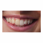 We Whiten Teeth Whitening Cosmetic Dentist in Albuquerque